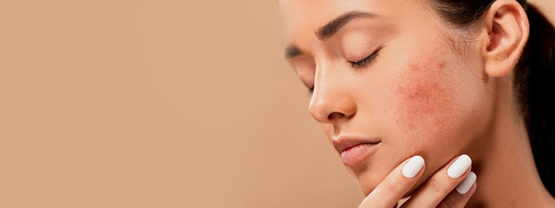 Acne: saiba o que é, as principais causas e como cuidar!
