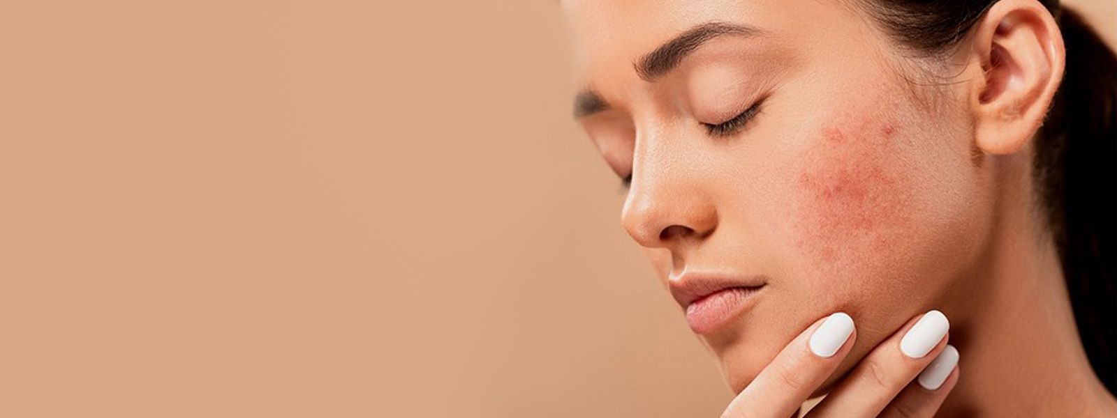 Acne: saiba o que é, as principais causas e como cuidar!