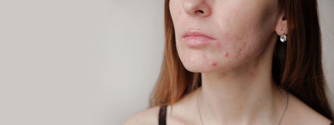 Foliculite: o que é e como tratar!