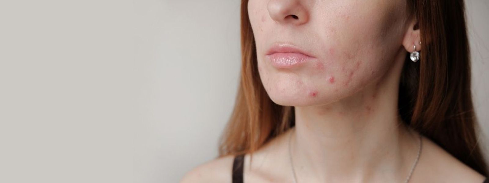 Foliculite: o que é e como tratar!