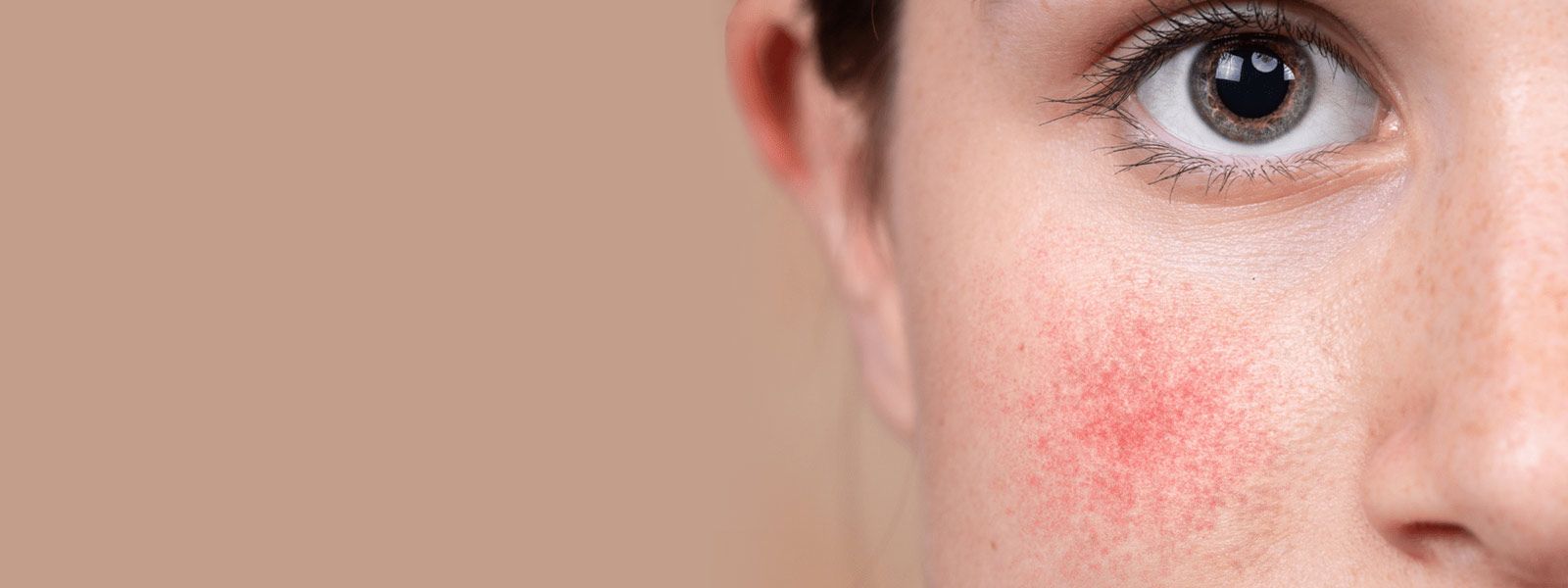 Rosácea: o que é e como tratar!
