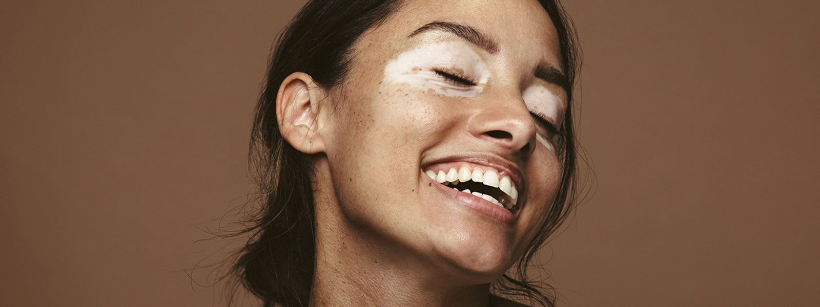 Vitiligo: o que é e como tratar?