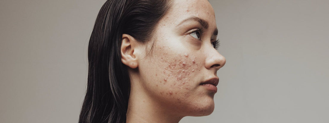 Acne hormonal: entenda as causas e qual o melhor tratamento
