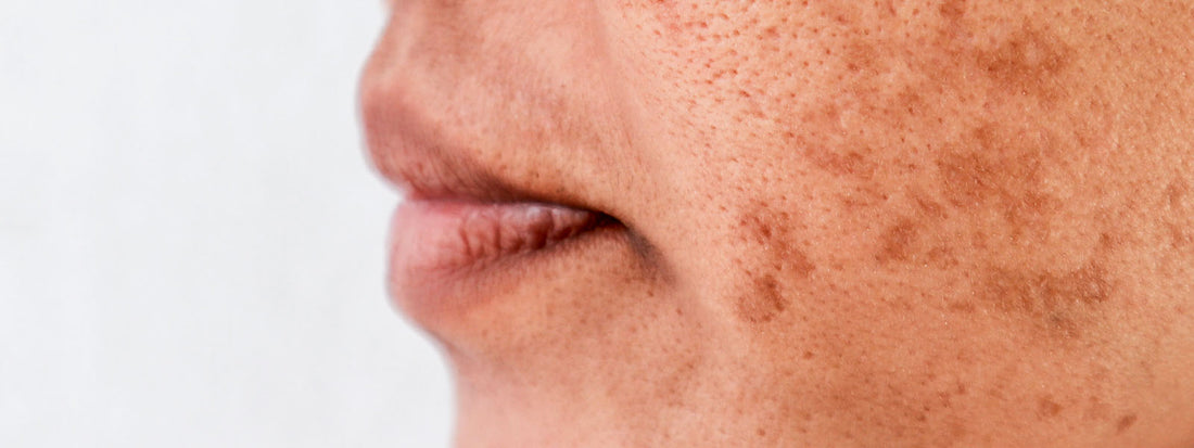 manchas-escuras-na-pele