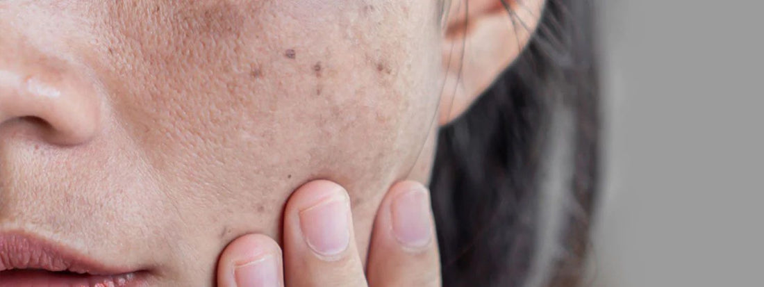 Melasma: sintomas, causas, tipos e tratamento