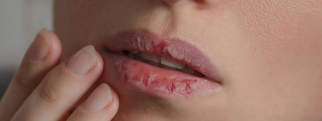 Lábios ressecados: o que causa e como cuidar?