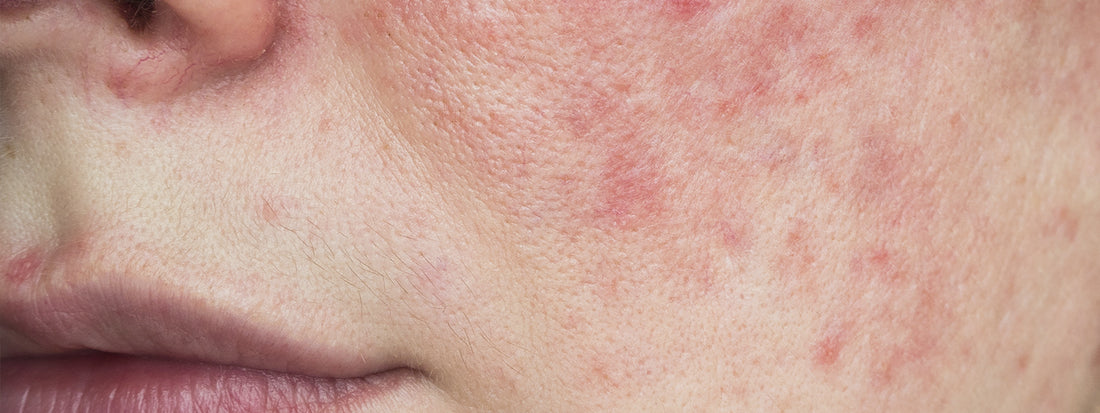 Alergia na pele: o que é, quais as causas e como tratar