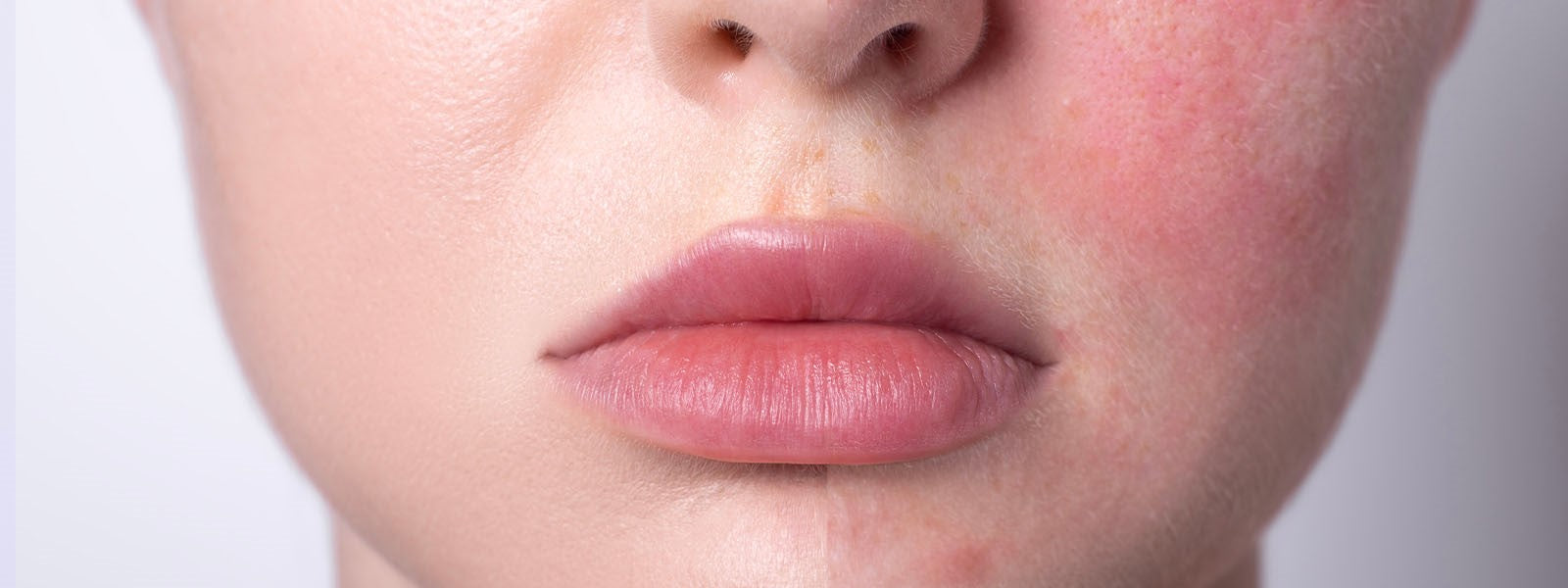 Alergia na pele: tipos, causas, sintomas e como tratar