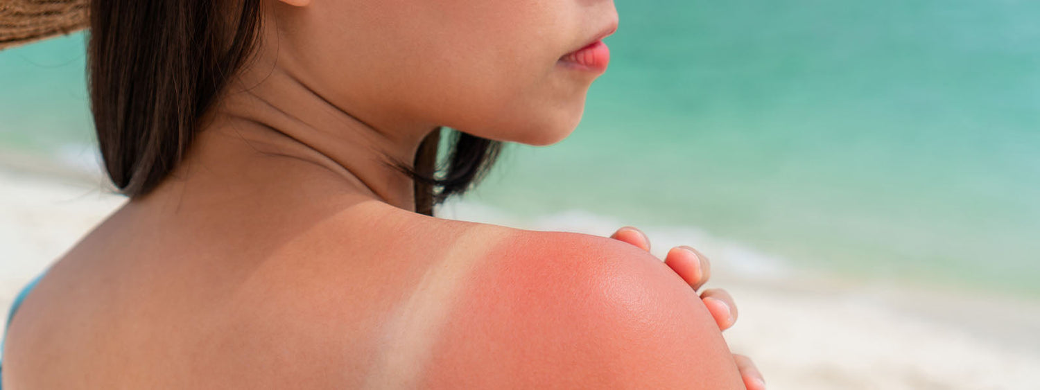 Queimadura solar: saiba como prevenir e tratar | CARE – CARE Natural Beauty